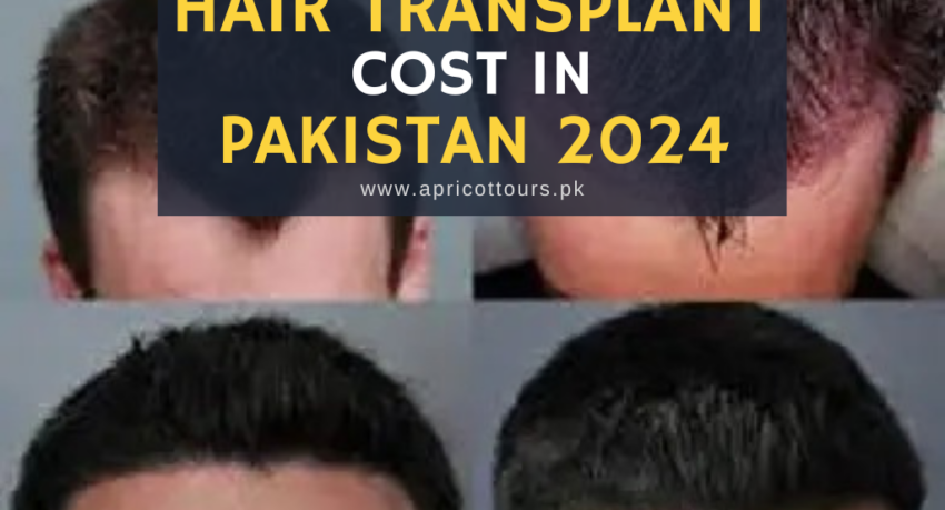 hair transplant cost in pakistan 2024