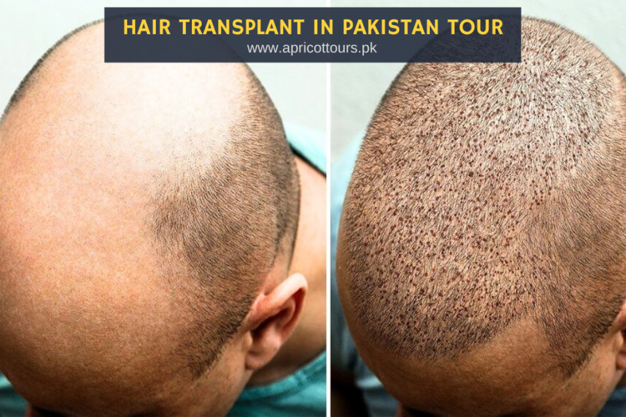 Hair Transplant in Pakistan Tour
